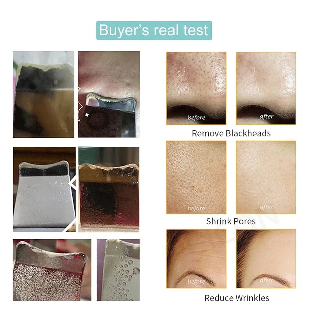 Face Blackhead Remover | Blackhead Remover Device | Essentialshouses